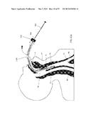 DEVICES AND METHODS FOR AIRWAY MEASUREMENT diagram and image