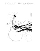 DEVICES AND METHODS FOR AIRWAY MEASUREMENT diagram and image