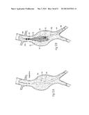 ENDOVASCULAR ANEURYSM DEVICES, SYSTEMS, AND METHODS diagram and image