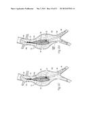 ENDOVASCULAR ANEURYSM DEVICES, SYSTEMS, AND METHODS diagram and image