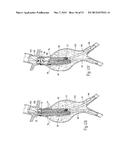 ENDOVASCULAR ANEURYSM DEVICES, SYSTEMS, AND METHODS diagram and image