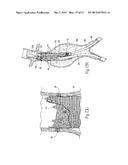 ENDOVASCULAR ANEURYSM DEVICES, SYSTEMS, AND METHODS diagram and image