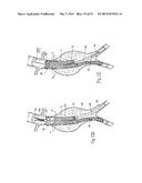 ENDOVASCULAR ANEURYSM DEVICES, SYSTEMS, AND METHODS diagram and image