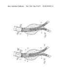 ENDOVASCULAR ANEURYSM DEVICES, SYSTEMS, AND METHODS diagram and image