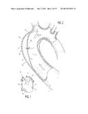 DEVICE AND METHOD FOR ANASTOMOSIS diagram and image