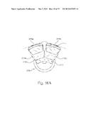 DEVICE AND METHOD FOR ANASTOMOSIS diagram and image