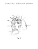 DEVICE AND METHOD FOR ANASTOMOSIS diagram and image