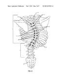 SPINAL CORRECTION SYSTEM AND METHOD diagram and image