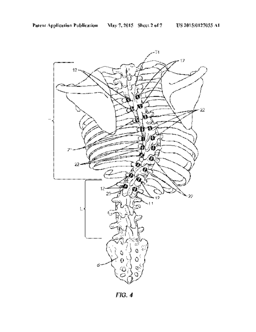 SPINAL CORRECTION SYSTEM AND METHOD - diagram, schematic, and image 03