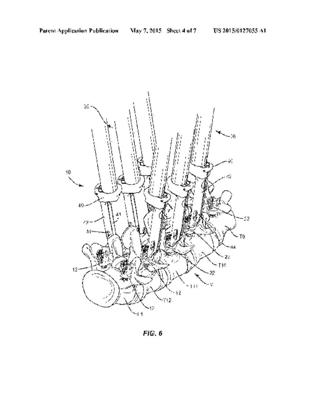 SPINAL CORRECTION SYSTEM AND METHOD - diagram, schematic, and image 05