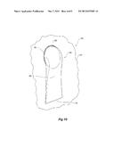 STENT GRAFT WITH VALVE ARRANGEMENT diagram and image