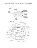 METHODS OF IMPLANTING AN ANNULOPLASTY RING FOR REDUCED DEHISCENCE diagram and image