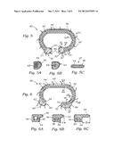 METHODS OF IMPLANTING AN ANNULOPLASTY RING FOR REDUCED DEHISCENCE diagram and image