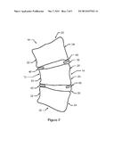 Method of Treating Scoliosis Using a Biological Implant diagram and image