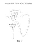 METHOD OF IMPLANTING A REVERSE SHOULDER ORTHOPAEDIC IMPLANT HAVING A     METAGLENE COMPONENT WITH A SCREW LOCKING CAP diagram and image