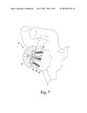 METHOD OF IMPLANTING A REVERSE SHOULDER ORTHOPAEDIC IMPLANT HAVING A     METAGLENE COMPONENT WITH A SCREW LOCKING CAP diagram and image