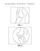 ANTERIOR STABILIZED KNEE IMPLANT diagram and image