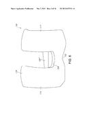 ANTERIOR STABILIZED KNEE IMPLANT diagram and image