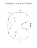 ANTERIOR STABILIZED KNEE IMPLANT diagram and image