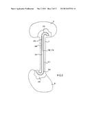 OPEN LUMEN STENT diagram and image