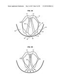 LARYNGEAL MASK WITH PIRIFORM-FOSSA CONDUIT diagram and image