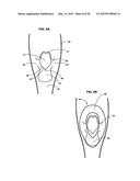 LARYNGEAL MASK WITH PIRIFORM-FOSSA CONDUIT diagram and image