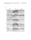 PTERYGIUM ANIMAL MODEL USING HUMAN PTERYGIAL EPITHELIAL CELLS diagram and image