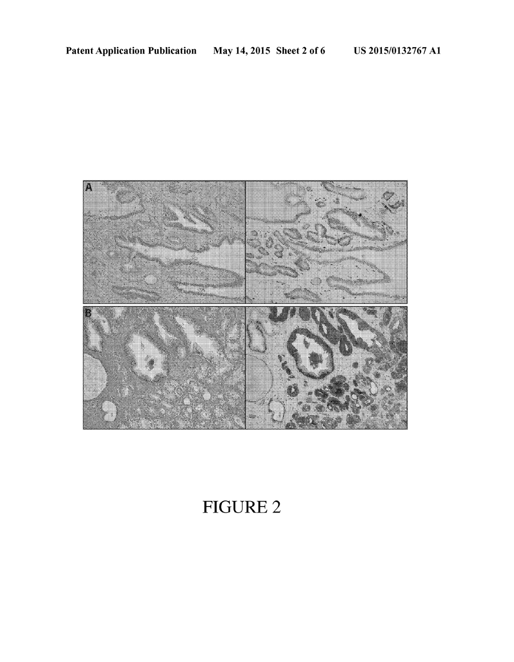 ERG/TFF3/HMWCK TRIPLE IMMUNOSTAIN FOR DETECTION OF PROSTATE CANCER - diagram, schematic, and image 03