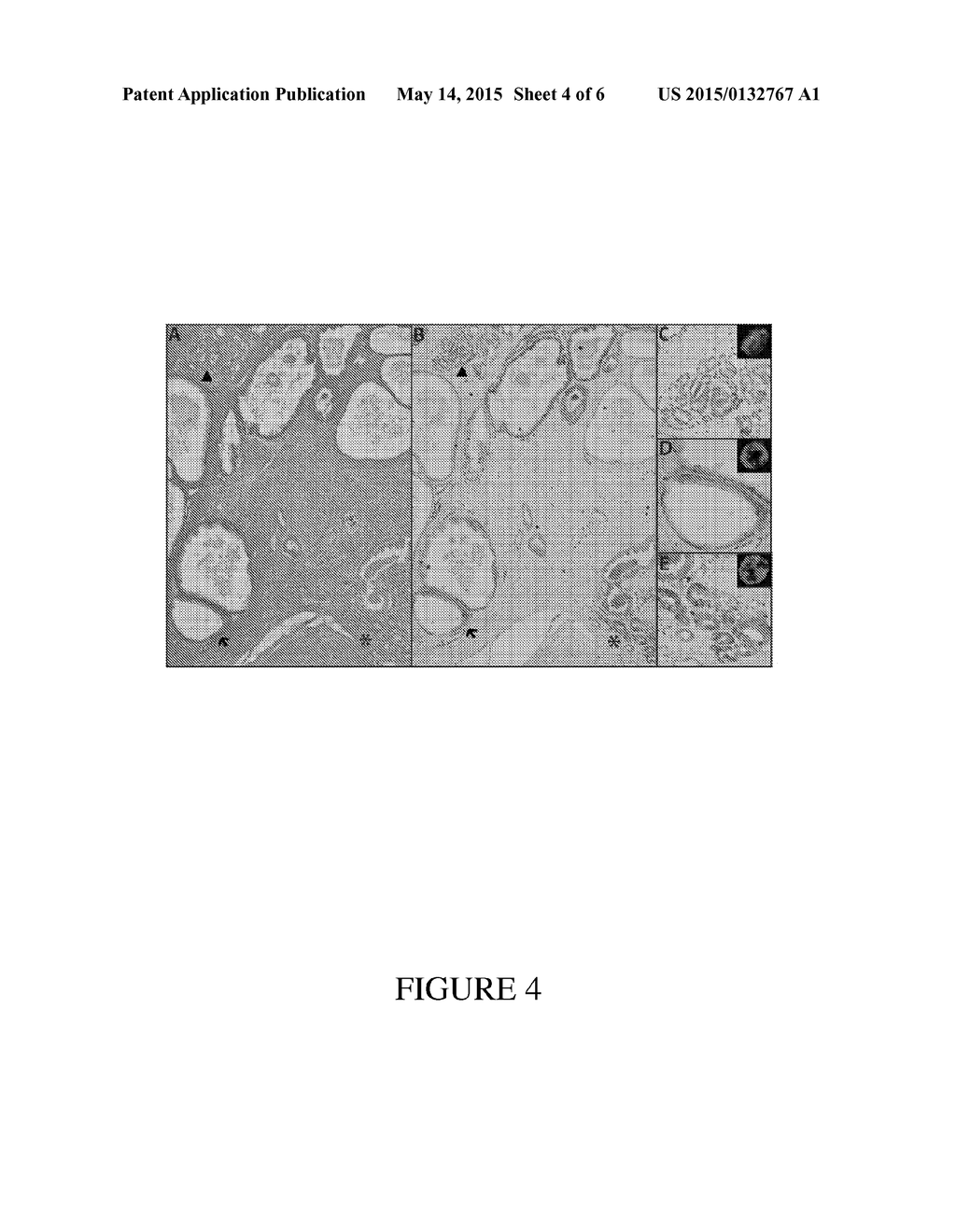 ERG/TFF3/HMWCK TRIPLE IMMUNOSTAIN FOR DETECTION OF PROSTATE CANCER - diagram, schematic, and image 05