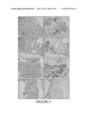 ERG/TFF3/HMWCK TRIPLE IMMUNOSTAIN FOR DETECTION OF PROSTATE CANCER diagram and image