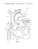 VENTRICULAR ASSIST DEVICE AND RELATED METHODS diagram and image