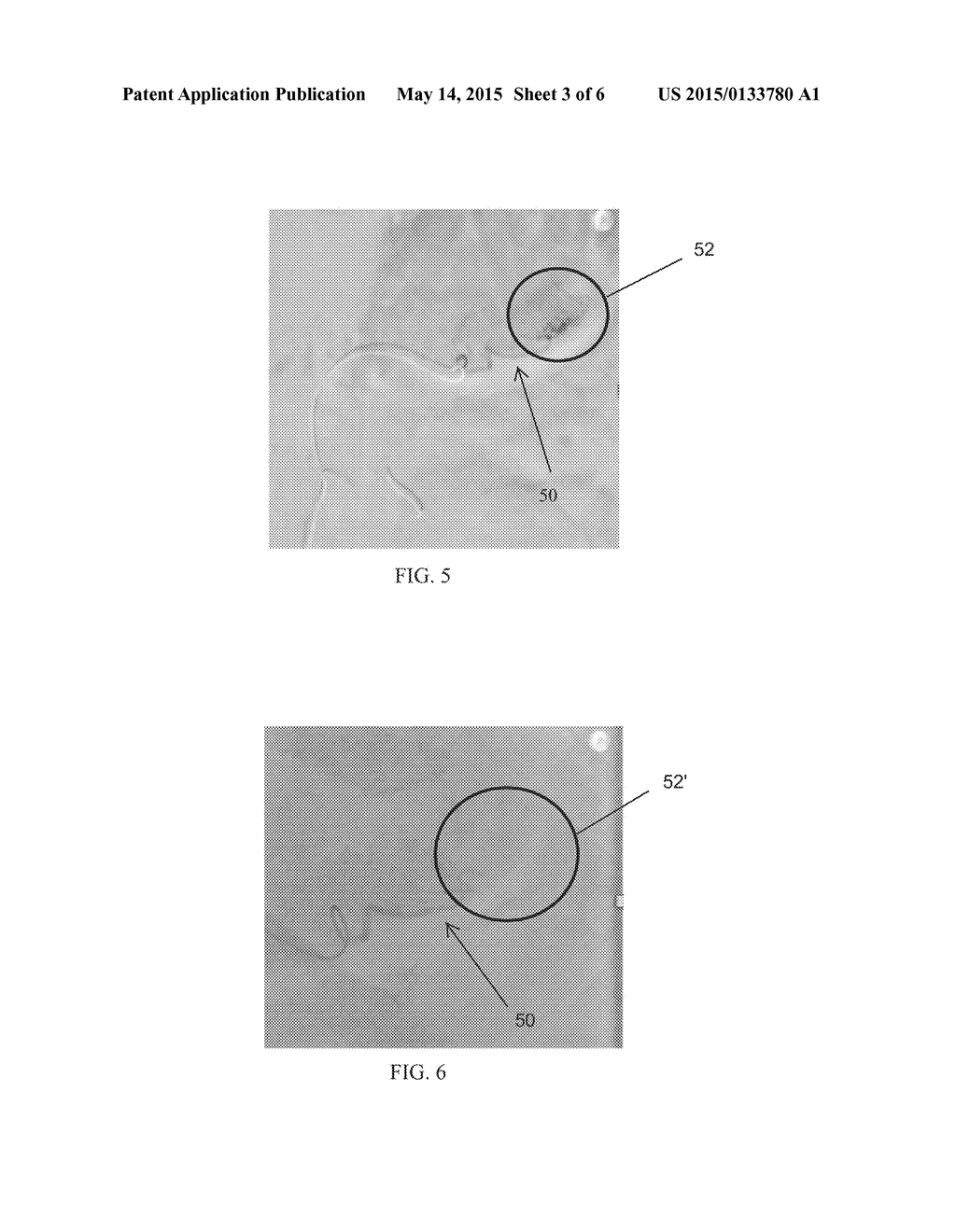 Selectively Delivering Particles into the Distal Portion of the Left     Gastric Artery - diagram, schematic, and image 04