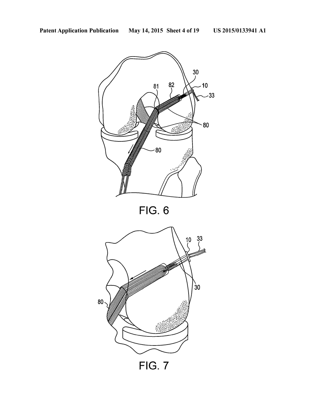 DRILL PIN FOR FIXATION OF LIGAMENTS USING BUTTON/LOOP CONSTRUCT - diagram, schematic, and image 05