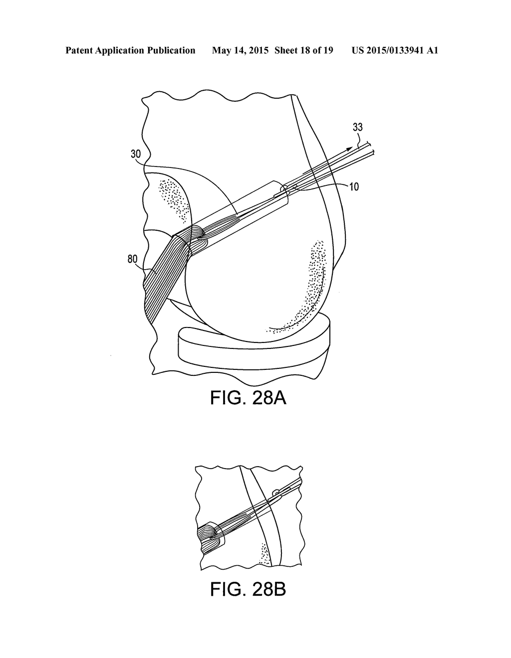 DRILL PIN FOR FIXATION OF LIGAMENTS USING BUTTON/LOOP CONSTRUCT - diagram, schematic, and image 19