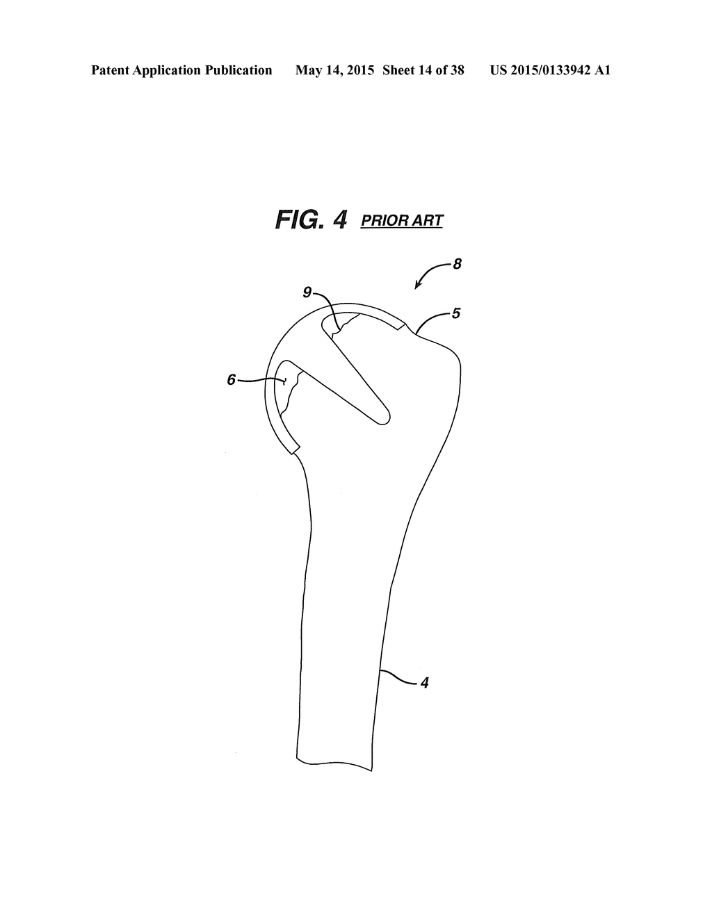 Arthroplasty Instruments and Associated Method - diagram, schematic, and image 15