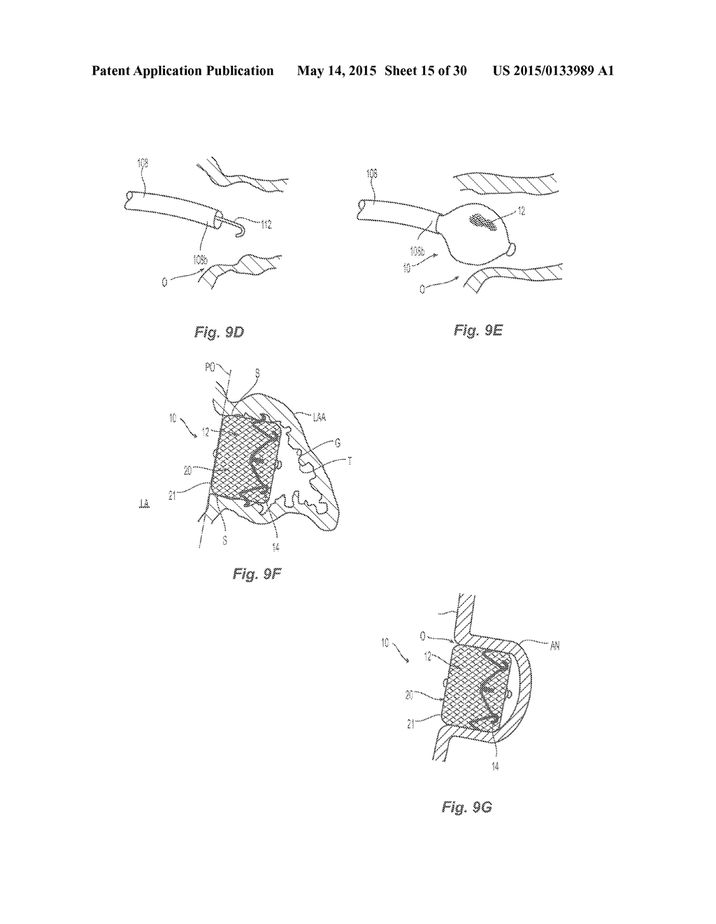 EXPANDABLE OCCLUSION DEVICES AND METHODS OF USE - diagram, schematic, and image 16