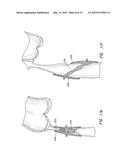 MULTI-LAYER BRAIDED STRUCTURES FOR OCCLUDING VASCULAR DEFECTS diagram and image