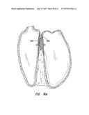 MULTI-LAYER BRAIDED STRUCTURES FOR OCCLUDING VASCULAR DEFECTS diagram and image