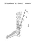 DEVICES AND METHODS FOR BONE FIXATION USING AXIAL IMPLANTS diagram and image