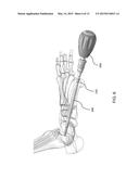 DEVICES AND METHODS FOR BONE FIXATION USING AXIAL IMPLANTS diagram and image