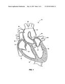 CATHETER DELIVERABLE ARTIFICIAL MULTI-LEAFLET HEART VALVE PROSTHESIS AND     INTRAVASCULAR DELIVERY SYSTEM FOR A CATHETER DELIVERABLE HEART VALVE     PROSTHESIS diagram and image