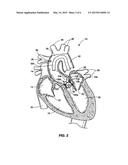 CATHETER DELIVERABLE ARTIFICIAL MULTI-LEAFLET HEART VALVE PROSTHESIS AND     INTRAVASCULAR DELIVERY SYSTEM FOR A CATHETER DELIVERABLE HEART VALVE     PROSTHESIS diagram and image