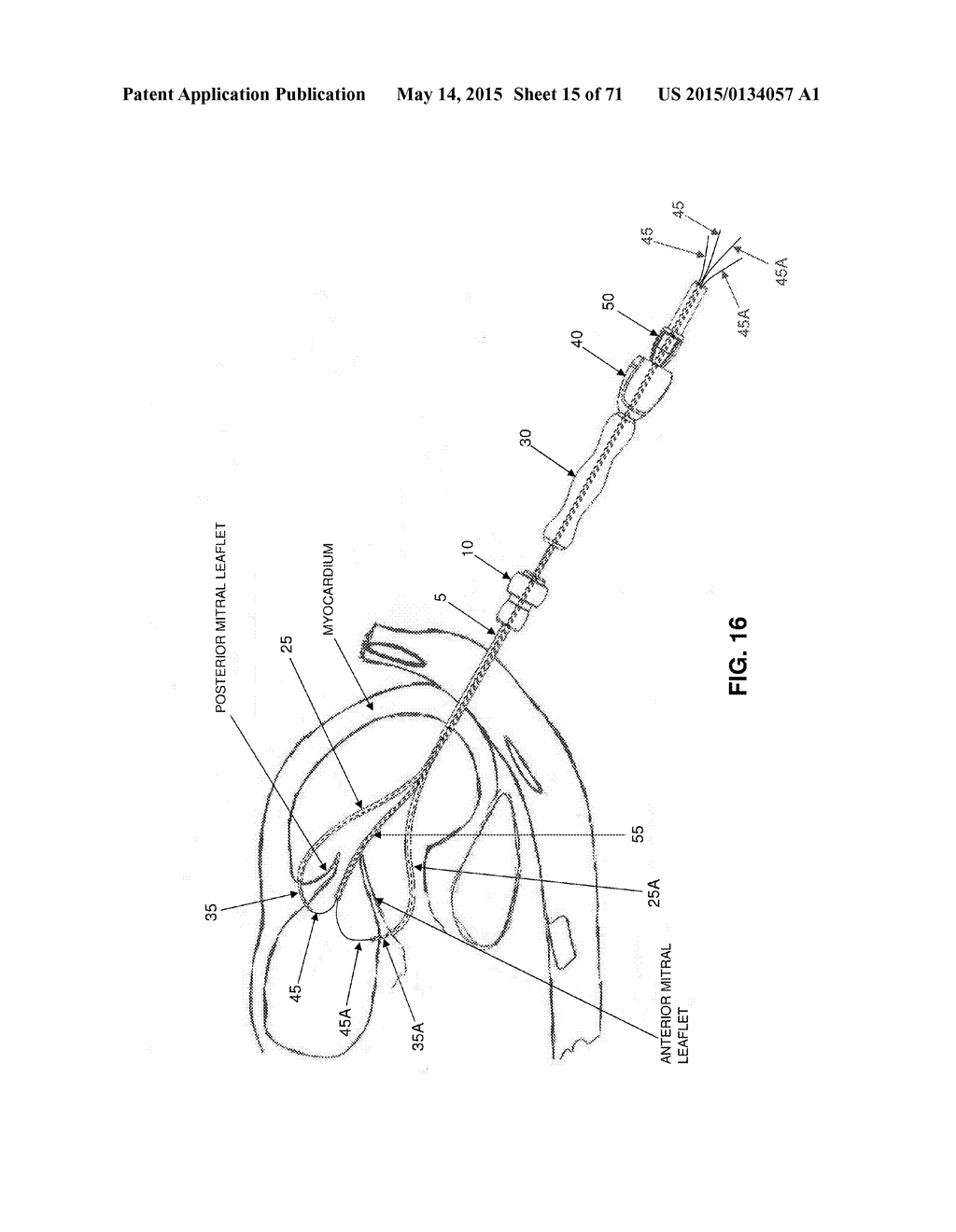 METHOD AND APPARATUS FOR REPAIRING A MITRAL VALVE - diagram, schematic, and image 16