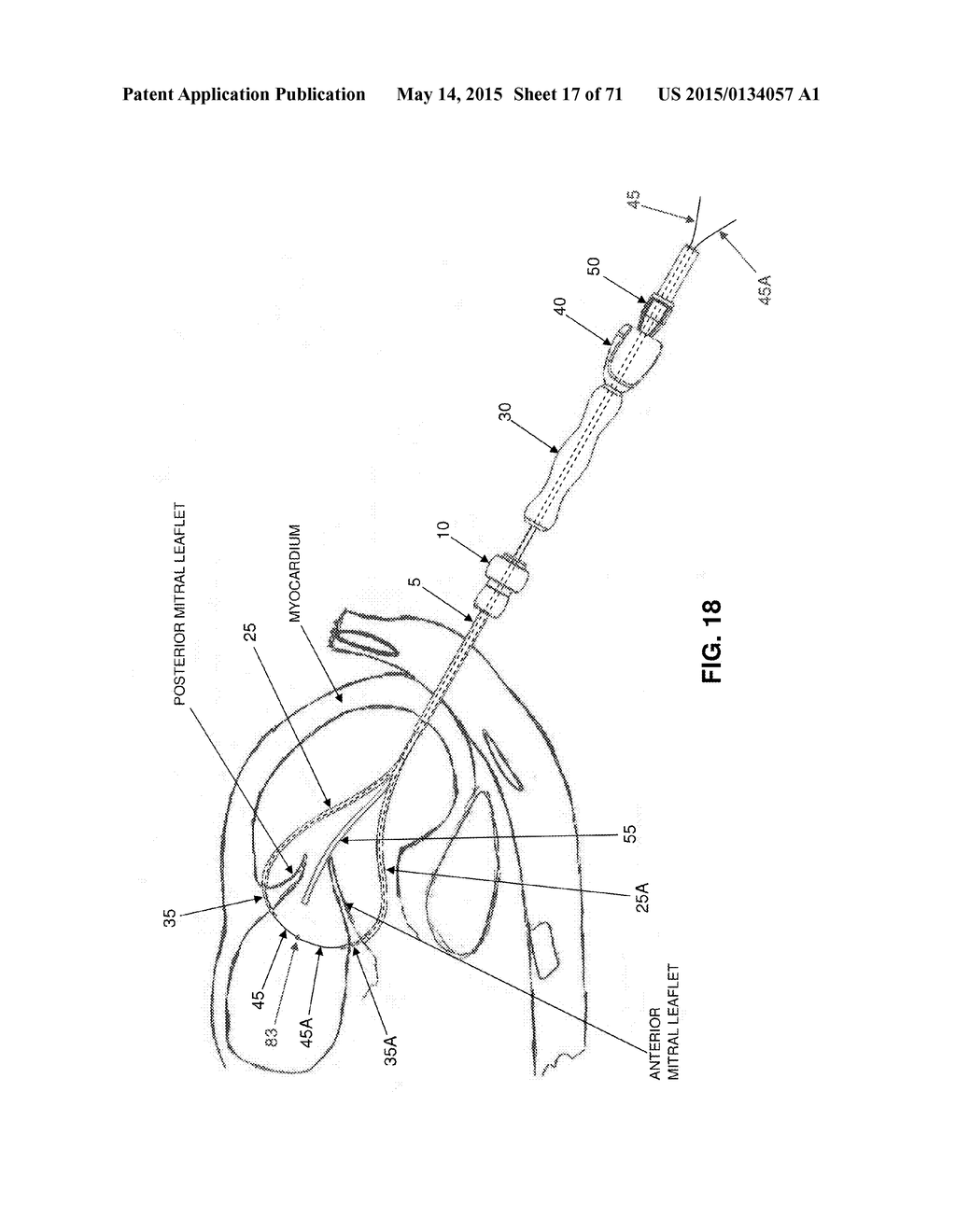 METHOD AND APPARATUS FOR REPAIRING A MITRAL VALVE - diagram, schematic, and image 18