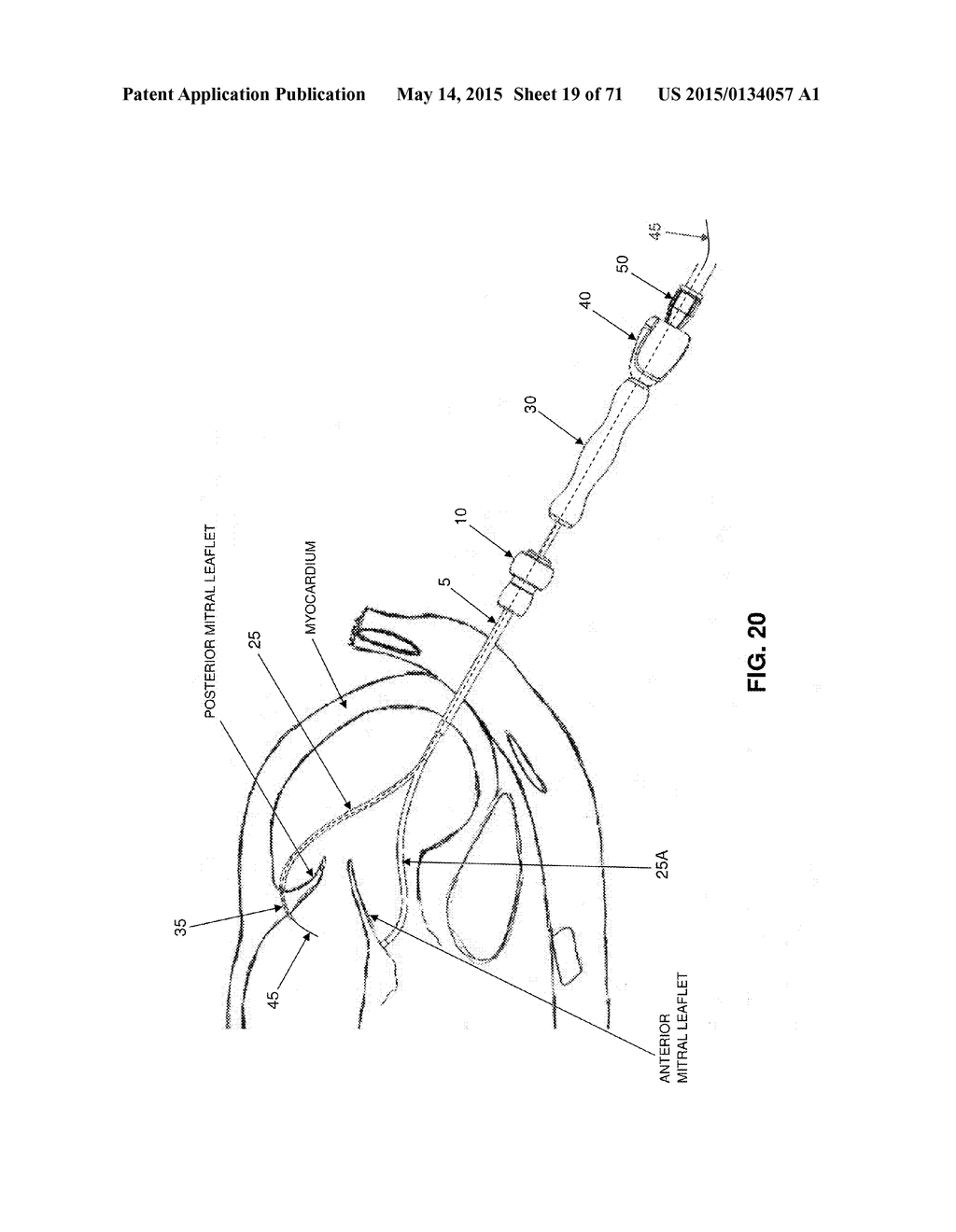 METHOD AND APPARATUS FOR REPAIRING A MITRAL VALVE - diagram, schematic, and image 20