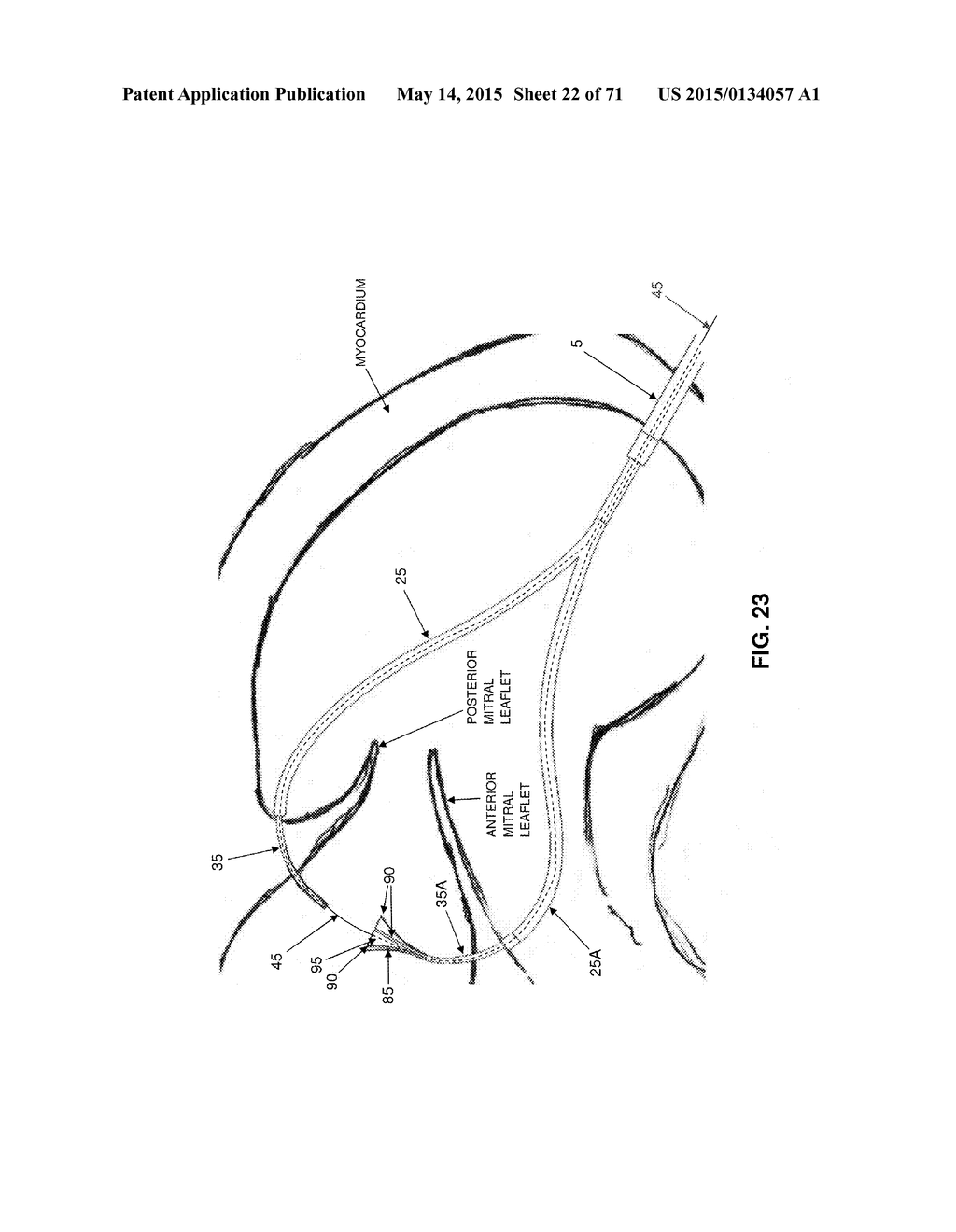 METHOD AND APPARATUS FOR REPAIRING A MITRAL VALVE - diagram, schematic, and image 23