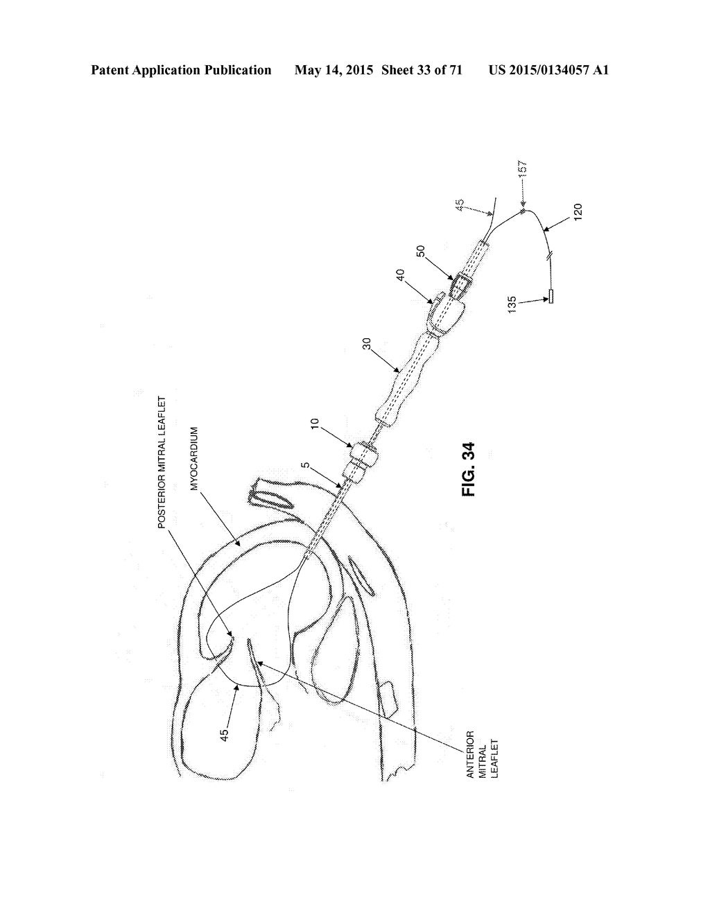 METHOD AND APPARATUS FOR REPAIRING A MITRAL VALVE - diagram, schematic, and image 34