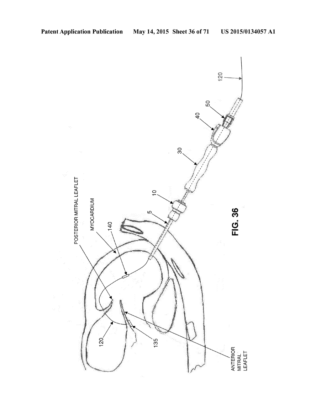 METHOD AND APPARATUS FOR REPAIRING A MITRAL VALVE - diagram, schematic, and image 37