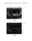 OCULAR TEAR FILM PEAK DETECTION AND STABILITZATION DETECTION SYSTEMS AND     METHODS FOR DETERMINING TEAR FILM LAYER CHARACTERISTICS diagram and image