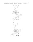 APPARATUS AND METHOD FOR INTRA-ABDOMINALLY MOVING A FIRST INTERNAL ORGAN     TO A POSITION AWAY FROM A SECOND INTERNAL ORGAN AND THEN HOLDING THE     FIRST INTERNAL ORGAN IN THE POSITION WITHOUT MANUAL INPUT diagram and image